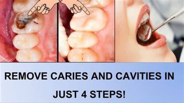 What is stepwise caries removal?
