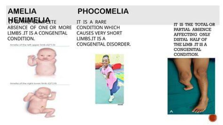 What is the cause of fibular hemimelia?