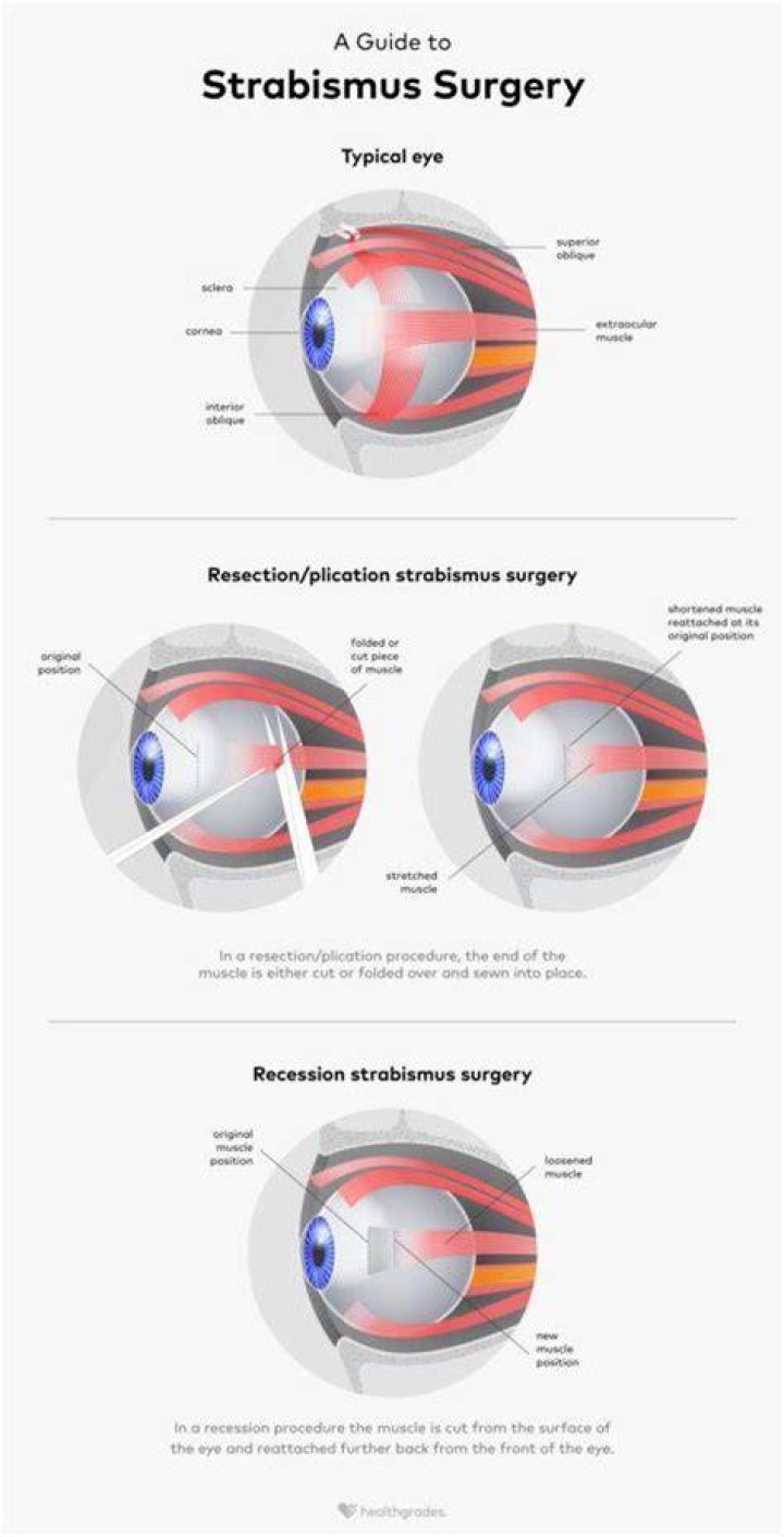 What is the cost of strabismus surgery in India?