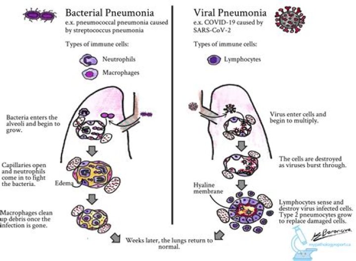 What is the most common cause of bacterial pneumonia?