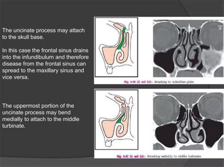 What is uncinate process of maxillary sinus?