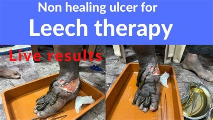 What kind of conditions can leech therapy treat?