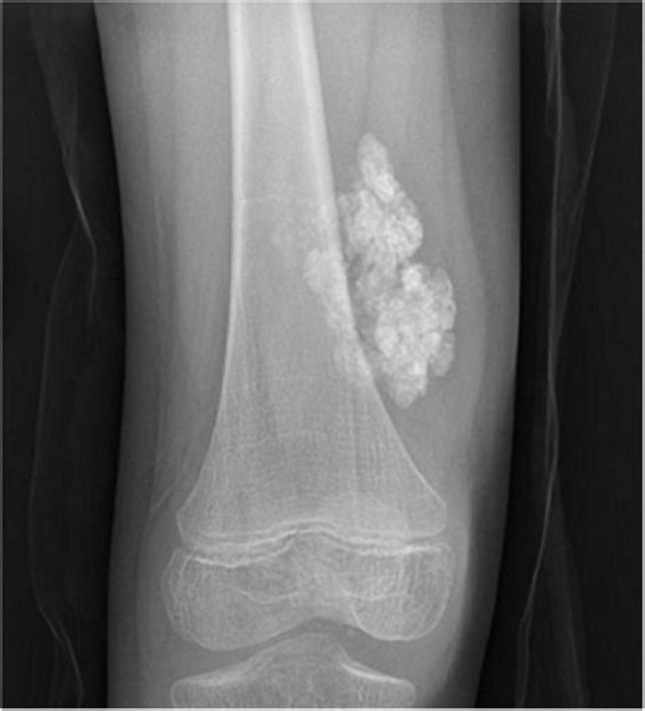 What kind of doctor treats calcinosis cutis?