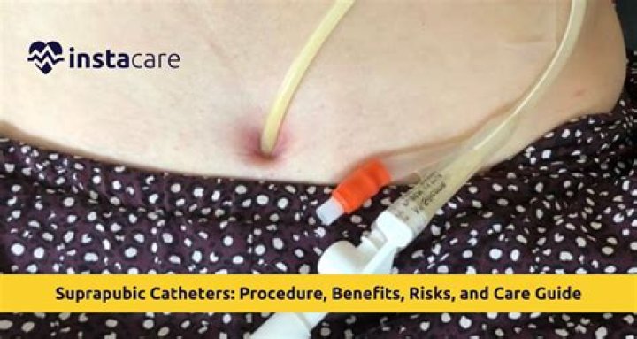 What type of catheter is used for suprapubic?