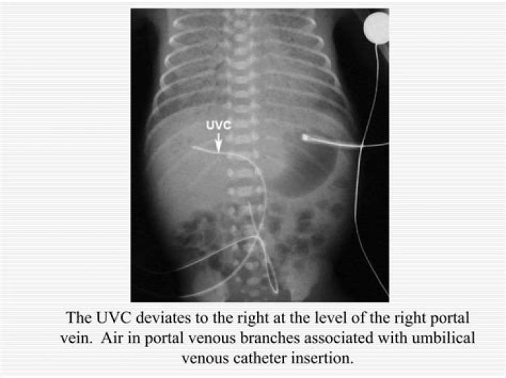 Where should a UVC be on xray?