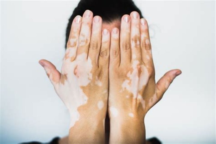 Why am I losing pigment on my hands?