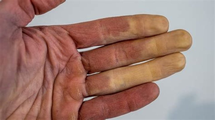 Why do my hands go blue?