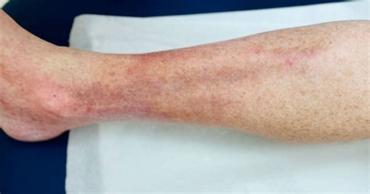 Why do my legs get rashes in the heat?