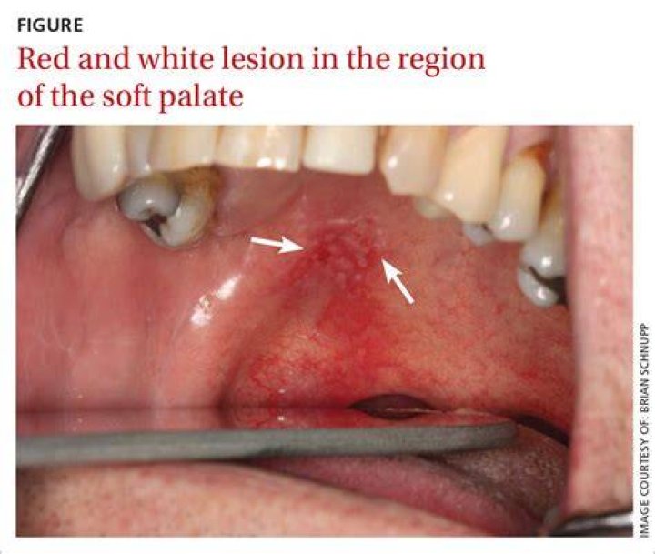 Why is my soft palate inflamed?